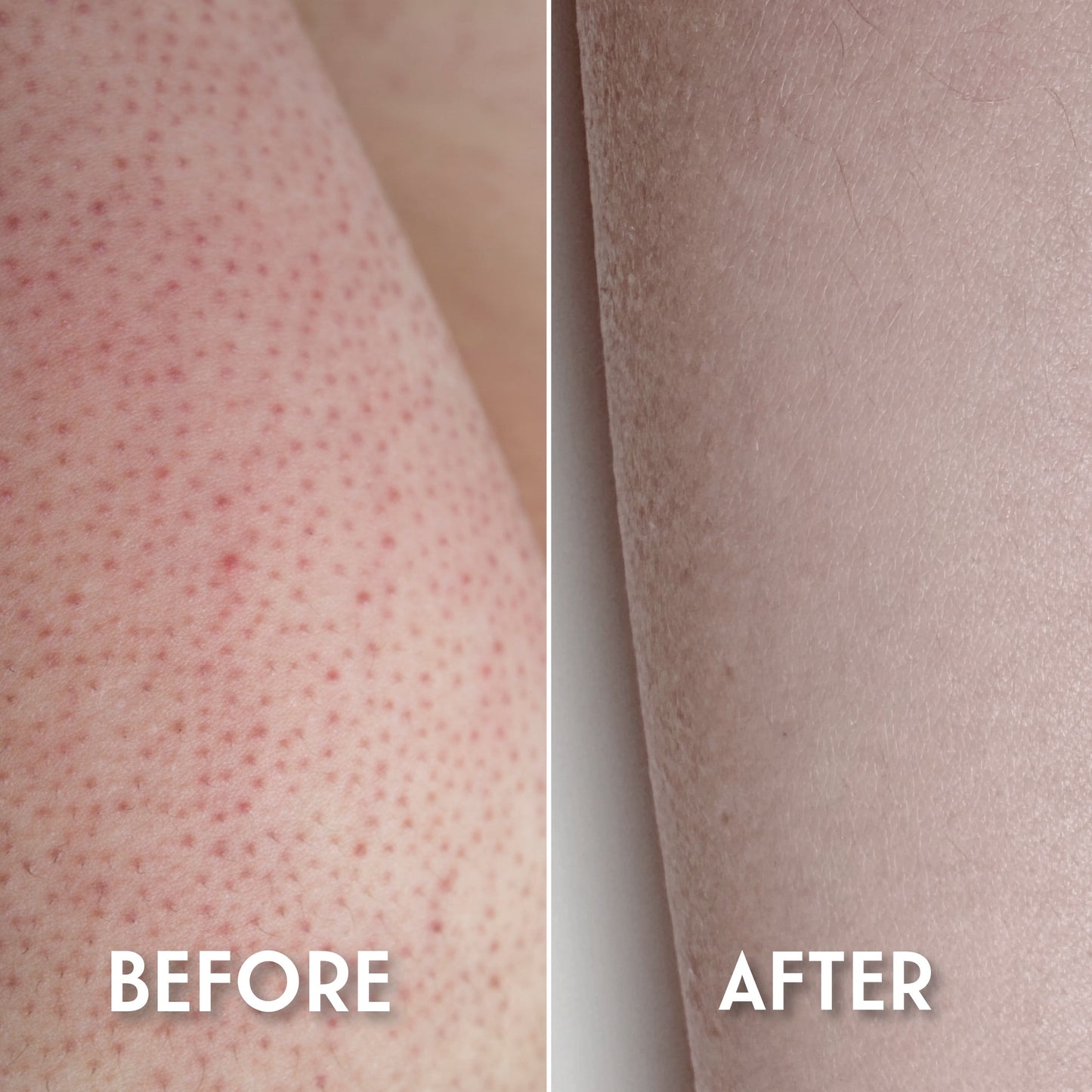 Keratosis Pilaris Body Scrub