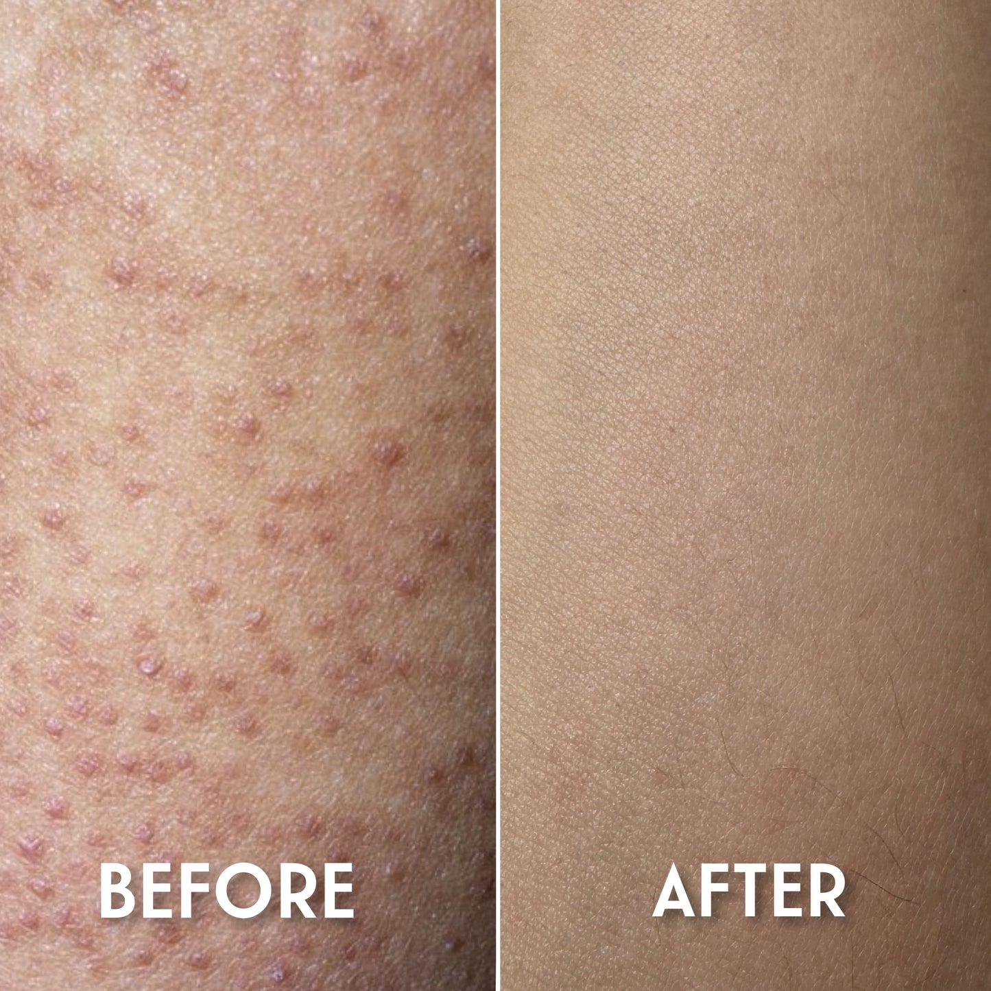 Keratosis Pilaris Body Cream