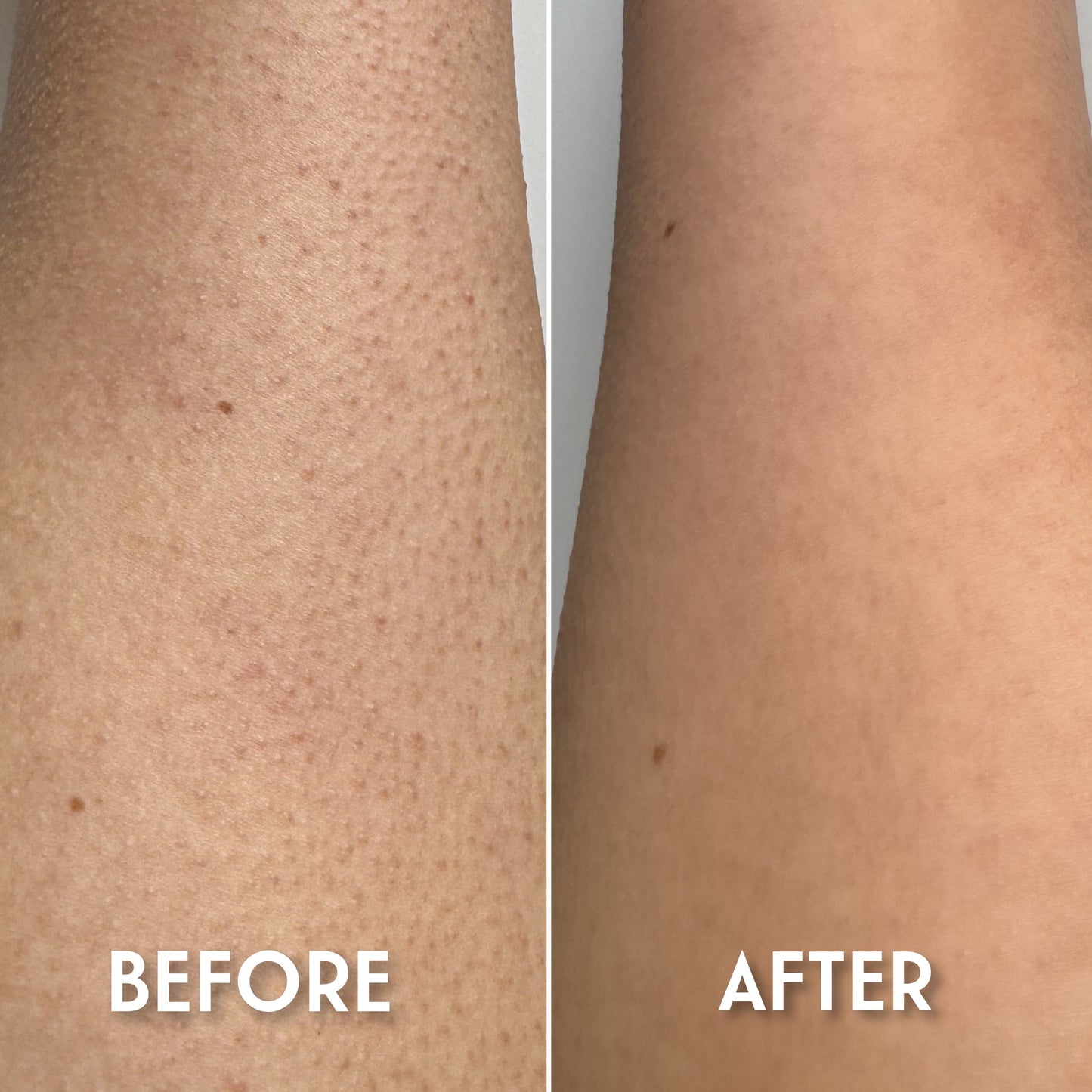 Keratosis Pilaris Body Cream