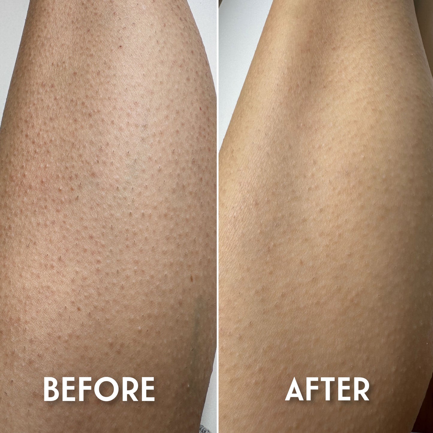 Keratosis Pilaris Body Cream