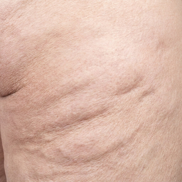 Cellulite