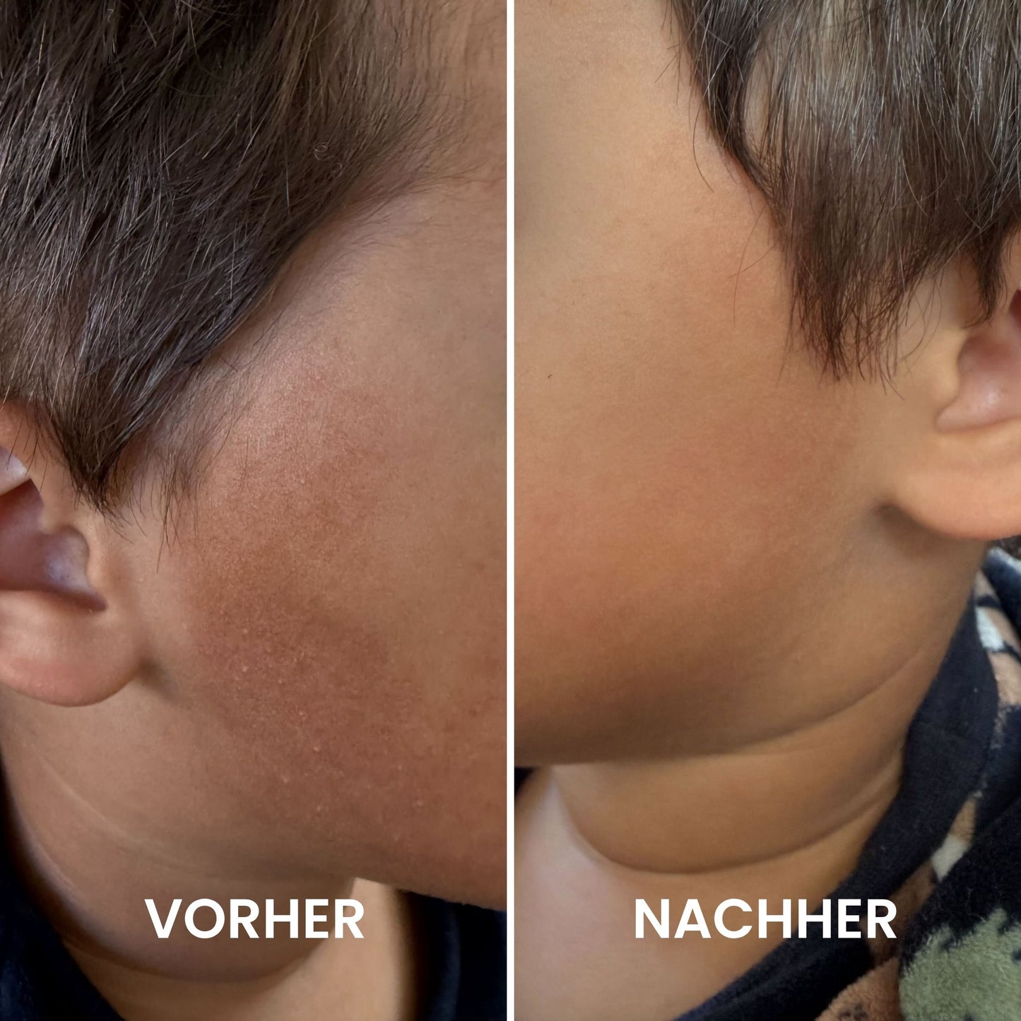 Kids & Teens Reibeisenhaut Set